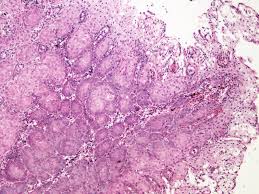 During adolescence the physiological transformation zone of the cervix in the virgin undergoes limited change when compared to that of girls who are sexually promiscuous; Pathology Outlines Squamous Metaplasia