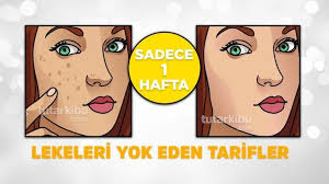 yuzdeki lekeleri 1 haftada yok eden tarifler 2020 dogal cilt bakimi cilt bakimi dogal cilt