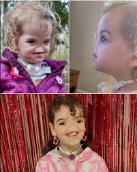 Girl born without nose thrives despite condition