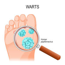 Athletes foot itches and burns, and over time it will get more painful. What Causes Foot Warts Cincinnati Foot Ankle Care