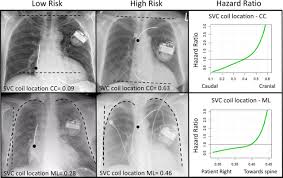 Cardiac pacemaker defibrillator icd crt difference pacemakers defibrillators devices resynchronization between medicine hospital implantable note anesthesia. Radiographic Predictors Of Lead Conductor Fracture Circulation Arrhythmia And Electrophysiology