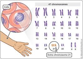 Down Syndrome