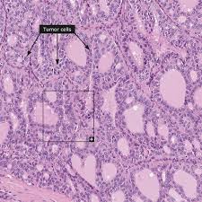 Annie is a character in an american comic strip little orphan annie. Dictionary Cancer Thyroid Cancer The Human Protein Atlas