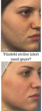 Yuzdeki Sivilce Izlerini Yok Etme Yollari Http Www Ciltsitesi Com Cilt Sorunlari Yuzdeki Sivilce Izleri Nasil Gecer Aknenarben Akne Narben Akne
