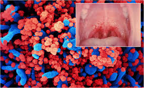 Tim spector recently reported covid tongue as a 'thing' but said it affects less than one in 100. A New Sign Of Covid 19 A Rash In The Mouth