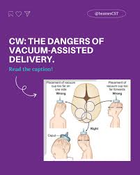 Image result for Vacuum Caput