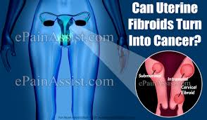 Uterine fibroids are a common type of noncancerous tumor that can grow in and on your uterus. Can Uterine Fibroids Turn Into Cancer