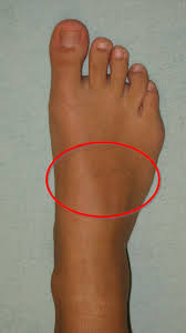 Mittelfussarthrose Ogam Orthopadie