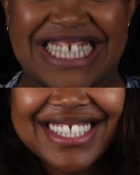 Our patient's goal was to improve his smile and close the gaps. This was  achieved with our hand sculpted in-chair composite veneers. So rewarding to  see his confident and happy smile! ✨ #