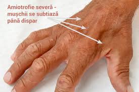 Dacă da, atunci citește în continuare acest articol și îți vom. Furnicaturi Si Amorteli In Maini Si Degete Tratament Dr Vladislav Gyebnar