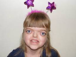 The real-life Wonder: Living with Crouzon Syndrome