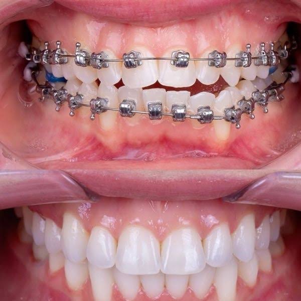 Best Braces Treatment in Pashan, Pune product image