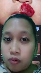 Pengalaman Mengenai Tanda Merah pada Bayi