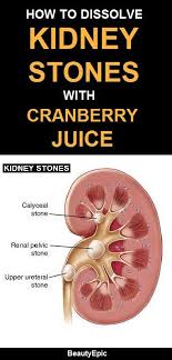 How Good Is Cranberry Juice For Kidney Stones Kidney Stones Kidney Stones Remedy Cranberry Juice