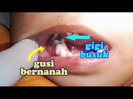 Penyakit gusi bengkak dan gusi tidak bengkak jangan diremehkan apalagi di abaikan karena bisa jadi tumbuh menjadi penyakit gusi akut susah di sembuhkan. Merawat Gusi Bernanah Dan Bengkak Sakit Gigi Pd Balita Anak Umur 3 Tahun Dokter Gigi Jogja Youtube