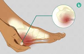 Get spur meaning in hindi at best online dictionary website. Bone Spur Symptoms Causes Treatment Medicine Prevention Diagnosis