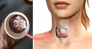 In cat timp ar trebui sa se vindece, in mod normal, avand in vedere evolutia de pana acum? Ètiai CÄ PoÈi Vindeca Ulcerul Gastrita Èi Tiroida Cu Cojile De La OuÄ Vezi Mai Jos Cum Secretele Com