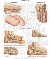 Image result for toe amputation