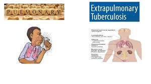 Image result for Extrapulmonary Tuberculosis