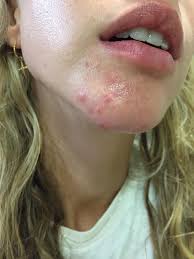 Malignant skin lesions called nodular melanoma. Hormonal Cystic Nodular Acne I Don T Eat Fair Or Gluten I M 34 Years Old And It S Worse Than Ever How Did You Stop Hormonal Cystic Acne 30plusskincare