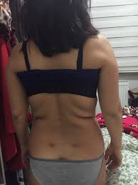 Lazerlipoliz Alper Tuncel Hastalari Kadinlar Kulubu