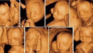 بدأ تطوير دوبلر اللون وتم إطلاق دوبلر ملون من سلسلة l. Ø§Ù„Ø§Ø³Ø¨ÙˆØ¹ 20 Ù…Ù† Ø§Ù„Ø­Ù…Ù„ ÙØ­Øµ Ø§Ù„Ù…ÙØµÙ„ Ø¨Ø§Ù„Ø§ÙŠÙƒÙˆ Ù…Ø³Ø­ ØªØ´ÙˆÙ‡Ø§Øª ÙÙŠ Ø§Ù„Ø§Ø¬Ù†Ù‡ Ù…Ø±ÙƒØ² Ø§Ù„Ø§Ø´Ø¹Ø© ÙˆØ³ÙˆÙ†Ø§Ø± Ø­ÙƒÙŠÙ… Ø§ÙˆØºÙ„Ùˆ