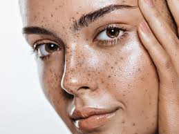 Image result for Freckled skin