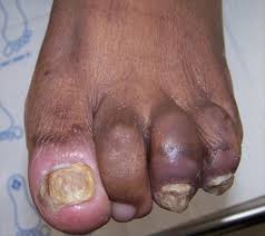 Image result for Pitting nails feet