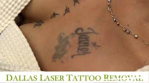 I consider it successful although not a perfect procedure. Dallas Laser Tattoo Removal During June 10 Off Pay It At 6 Months No Interest Facebook