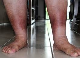 Image result for Stasis Dermatitis