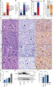 Regulated lysosomal exocytosis mediates cancer progression