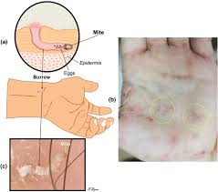 Image result for scabies in the groin area