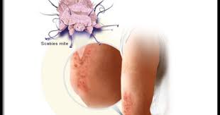 Scabies Pictures Slideshow Stop The Itch Mite On Medicinenet Com Home Remedies For Scabies Remedies Herbal Remedies