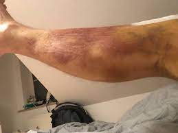 Finde Heraus Ob Dein Bluterguss Nach Knie Op Harmlos Ist Oder Nicht Knie Marathon Knie Op Reha Patienten Aufgepasst