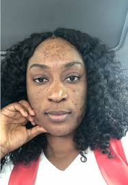 Hyperpigmentation Girl Front View