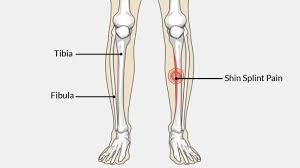 Image result for Shin Splints