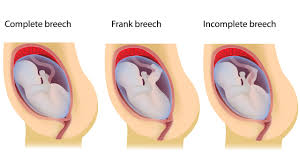Bayi opick dan wulan ini meninggal dunia dalam kandungan di usia delapan bulan. Mengenal 3 Jenis Posisi Sungsang Pada Janin Kumparan Com