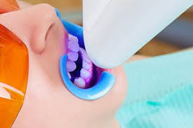 When you have braces, it may seem like nothing is more difficult than keeping them properly clean. Teeth Whitening Nhs
