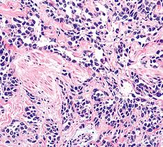 We did not find results for: Malignant And Borderline Mesothelial Tumors Of The Pleura Clinical Gate