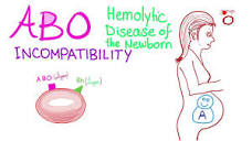 ABO Incompatibility And Hemolytic Disease Of The Newborn (HDN ...