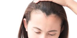 Hairstyles for big forehead and round face hairstyles for women with thin hair and big forehead 2021. How To Stop And Regrow A Receding Hairline Best Treatments Allure