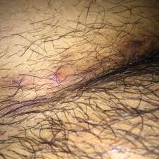 For most women, ingrown hair on privy area is such an irritating condition. I Have Extreme Ingrown Hairs On My Pubic Area Would Laser Treatment Be Best Photos