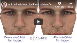 Customized Infraorbital Rim Implant Beverly Hills