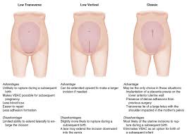 Uterine Incisions For Cesarean Birth Abdominal And Uterine Incisions Do Not Always Match Nursing Care Nurse Nursing Care Plan