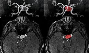 Daselbst) oder in ihrer umgebung vorkommende, in ihrem innern blut enthaltende, geschwulst, welche entsteht entweder. Que Pruebas Imagenologicas Utilizar Para Detectar Aneurismas Cerebrales