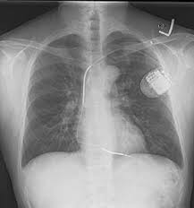 Image result for Internal Cardiac Defibrillator