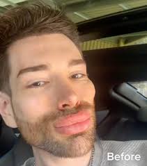 A Man Shows Off His Plastic Surgery Results, and It Shocks People