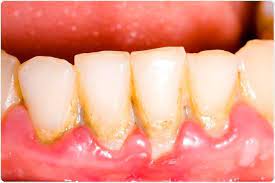 Gum Ache Near The Tooth What Is The Reason