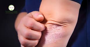 Image result for psoriasis