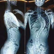 Here Is A Very Interesting Radiograph Showing A Case Of Scoliosis And Dextrocardia Scoliosis Is An Abnormal Lateral Curvature Of The Spine Dextrocardia Is A R